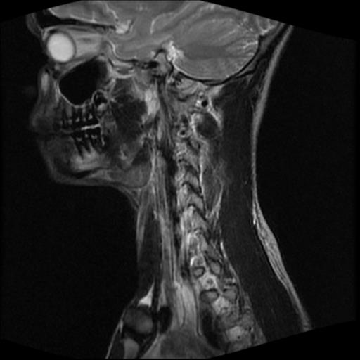 File:Carotid body tumor (Radiopaedia 30208-30823 Sagittal T2 7).jpg