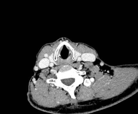 Carotid body tumor (Radiopaedia 61750-69757 Axial Post contrast 86).jpg