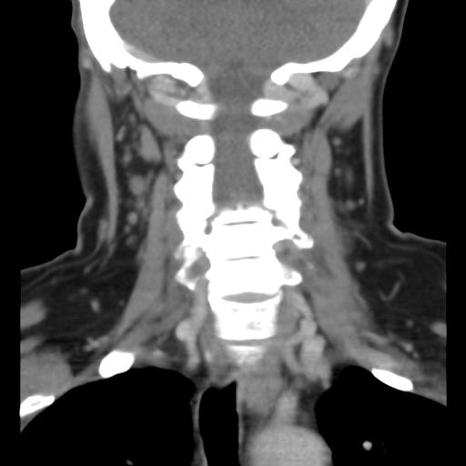 File:Carotid body tumor (paraganglioma) (Radiopaedia 38586-40729 B 29).jpg