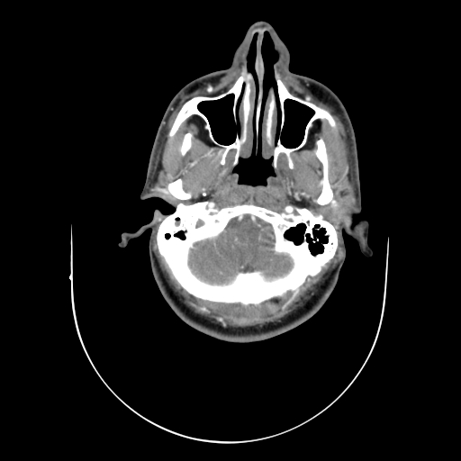 File:Carotid bulb pseudoaneurysm (Radiopaedia 57670-64616 A 3).jpg