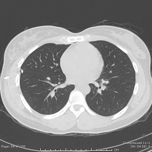 File:Catamenial pneumothorax (Radiopaedia 54382-60600 Axial non-contrast 54).jpg