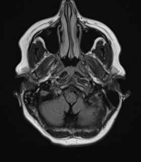 File:Cavernoma with bleed - midbrain (Radiopaedia 54546-60774 Axial FLAIR 5).png