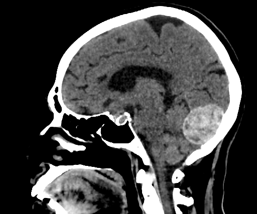 Cavernous hemangioma of the cerebellar falx (Radiopaedia 73025-83723 B 152).jpg