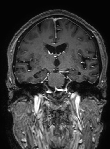 Cavernous hemangioma of the cerebellar falx (Radiopaedia 73025-83724 Coronal T1 C+ 190).jpg