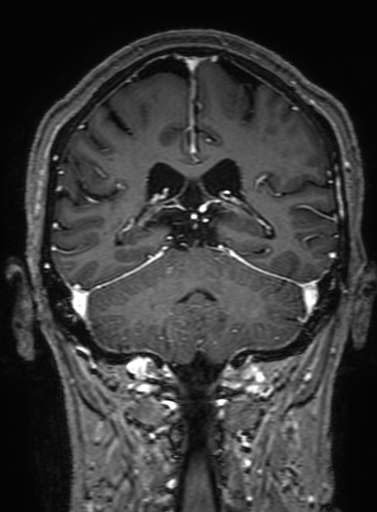 Cavernous hemangioma of the cerebellar falx (Radiopaedia 73025-83724 Coronal T1 C+ 247).jpg