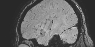 Cavernous hemangioma of the cerebellar falx (Radiopaedia 73025-83724 Sagittal BOLD 42).jpg