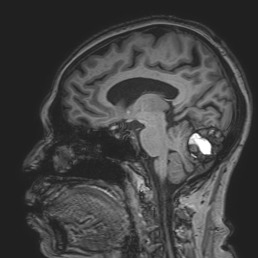 File:Cavernous hemangioma of the cerebellar falx (Radiopaedia 73025-83724 Sagittal T1 96).jpg