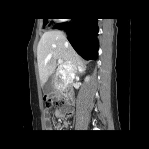 Cavernous hepatic hemangioma (Radiopaedia 75441-86667 D 74).jpg