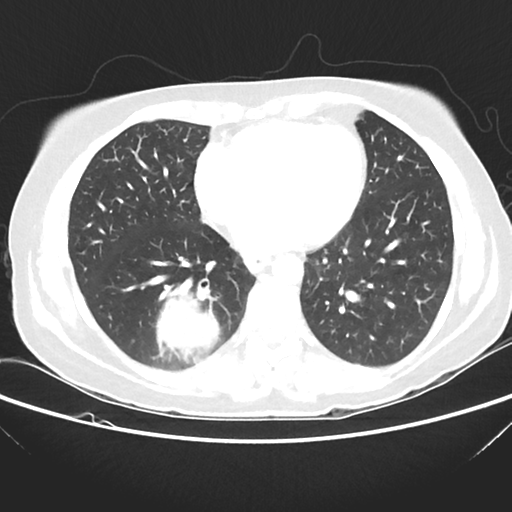 File:Cavitating lung mass - squamous cell carcinoma (Radiopaedia 48047-52854 Axial lung window 32).png