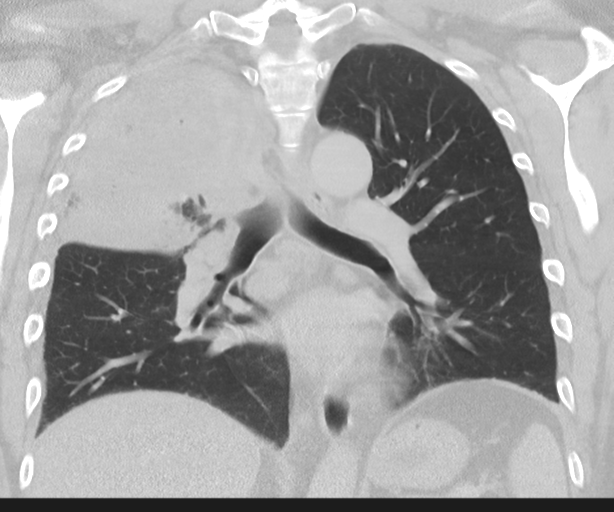 Cavitating pneumonia (Radiopaedia 45998-50329 Coronal lung window 30).png