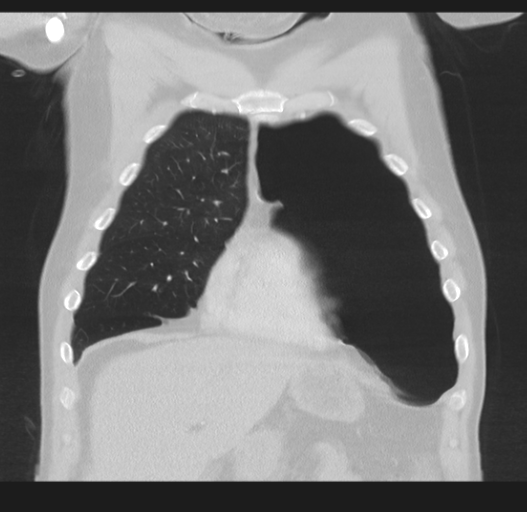 Cavitating pneumonia complicated by pneumothorax (Radiopaedia 48149-52994 Coronal lung window 16).png