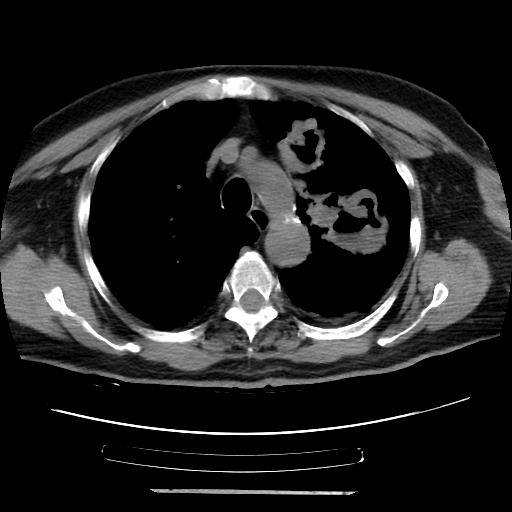 Cavitating pulmonary metastases (Radiopaedia 89545-106544 Axial non-contrast 17).jpg