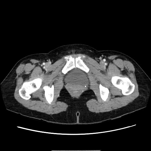 Cecal adenocarcinoma (Radiopaedia 75909-87331 A 88).jpg