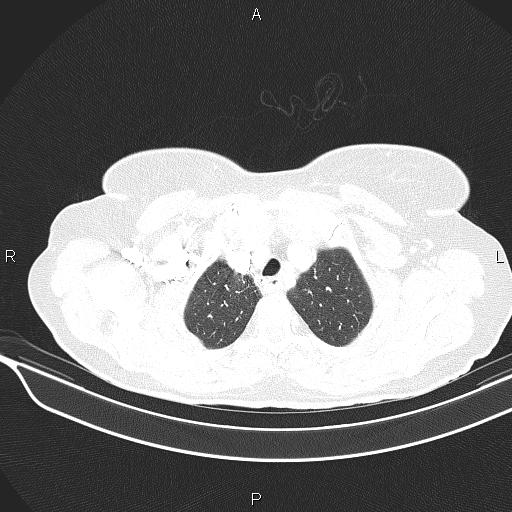Cecal cancer (Radiopaedia 85610-101358 Axial lung window 11).jpg