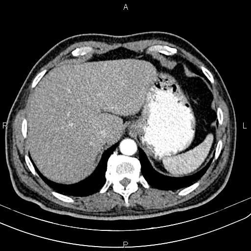 Cecal cancer with appendiceal mucocele (Radiopaedia 91080-108651 A 58).jpg