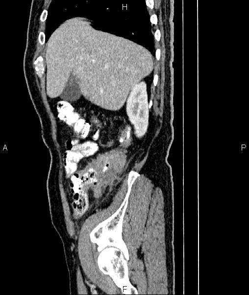 Cecal cancer with appendiceal mucocele (Radiopaedia 91080-108651 E 20).jpg