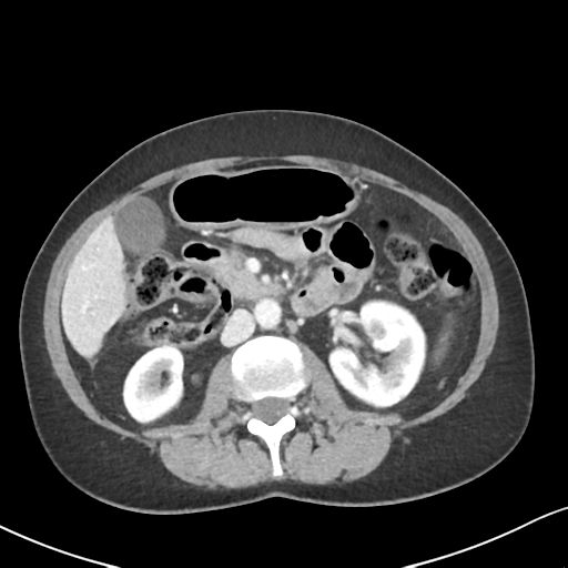 Cecal internal hernia through the foramen of Winslow (Radiopaedia 44820-48651 B 33).png
