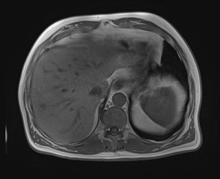 File:Cecal mass causing appendicitis (Radiopaedia 59207-66532 Axial T1 in-phase 29).jpg
