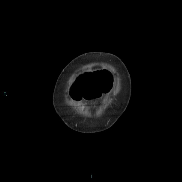 Cecal volvulus (Radiopaedia 71372-81698 C 7).jpg
