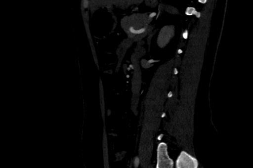 Celiac artery compression syndrome (Radiopaedia 47538-52152 B 73).jpg