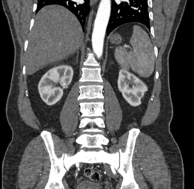 Celiac artery dissection (Radiopaedia 52194-58080 C 109).jpg