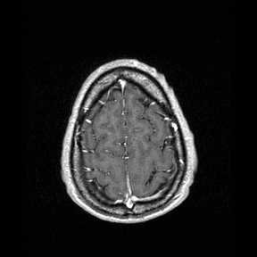 File:Central-variant posterior reversible encephalopathy syndrome (PRES) (Radiopaedia 43880-47358 Axial T1 C+ 149).jpg