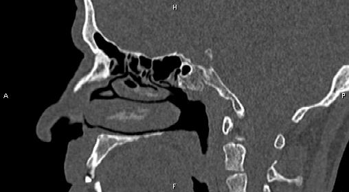 File:Central giant cell granuloma (Radiopaedia 83346-97761 Sagittal bone window 27).jpg