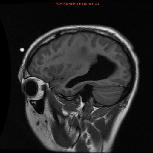 File:Central neurocytoma (Radiopaedia 13188-13206 Sagittal T1 1).jpg