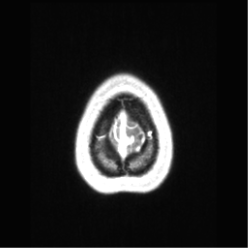 File:Central neurocytoma (Radiopaedia 37664-39557 Axial T1 C+ 75).png