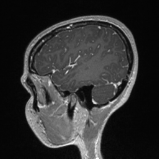 Central neurocytoma (Radiopaedia 37664-39557 Sagittal T1 C+ 21).png