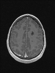 Central neurocytoma (Radiopaedia 56690-63469 Axial T1 C+ 130).jpg