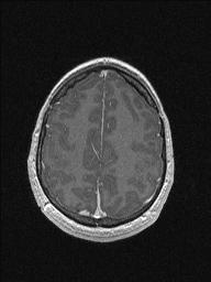 Central neurocytoma (Radiopaedia 56690-63469 Axial T1 C+ 133).jpg
