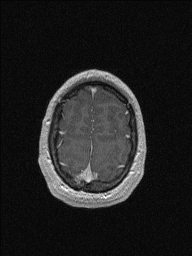 Central neurocytoma (Radiopaedia 56690-63469 Axial T1 C+ 146).jpg