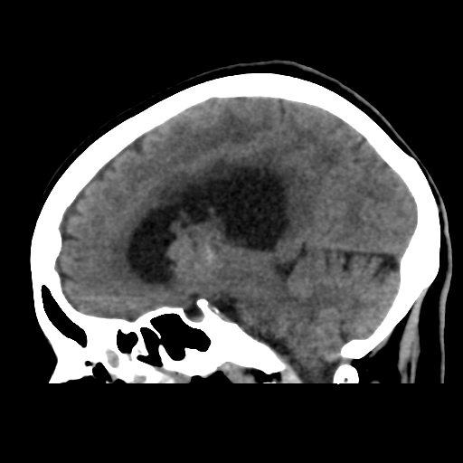 File:Central neurocytoma (Radiopaedia 65317-74346 C 30).png