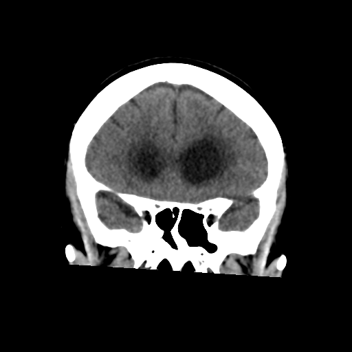 File:Central neurocytoma (Radiopaedia 65317-74346 Coronal non-contrast 20).png