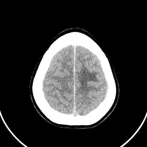Central neurocytoma (Radiopaedia 84497-99871 Axial non-contrast 45).jpg