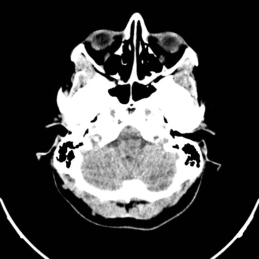 Central neurocytoma (Radiopaedia 84497-99871 Axial non-contrast 5).jpg