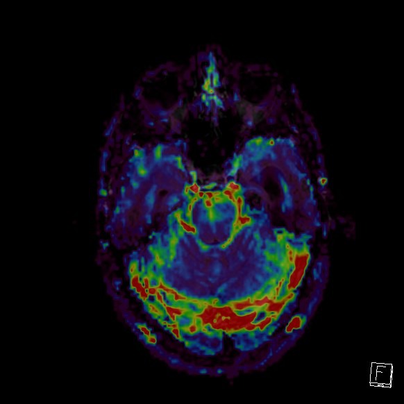 Central neurocytoma (Radiopaedia 84497-99872 Axial Perfusion 231).jpg