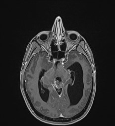 Central neurocytoma (Radiopaedia 84497-99872 Axial T1 C+ 64).jpg