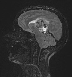 Central neurocytoma (Radiopaedia 84497-99872 Sagittal Flair + Gd 85).jpg