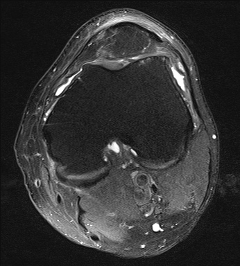 File:Central osteophyte (Radiopaedia 72592-83150 Axial PD fat sat 13).jpg