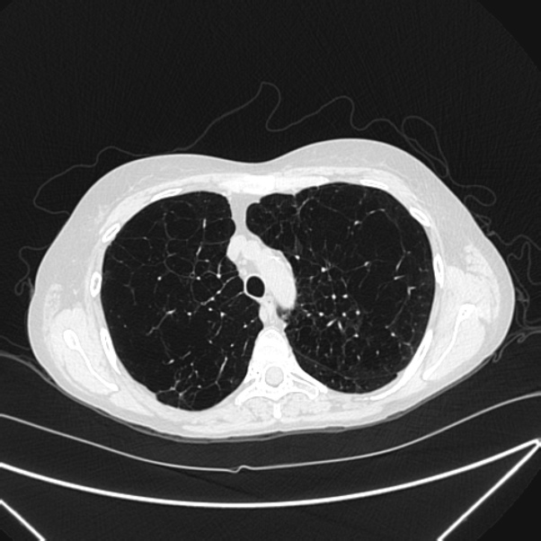 Centrilobular pulmonary emphysema (Radiopaedia 24495-24789 Axial lung window 28).jpg