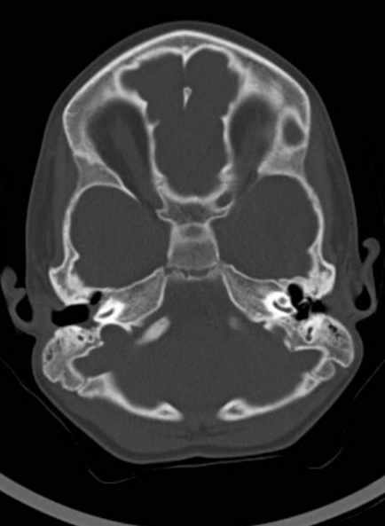 Cerebellar abscess (Radiopaedia 73727-84527 Axial bone window 24).jpg