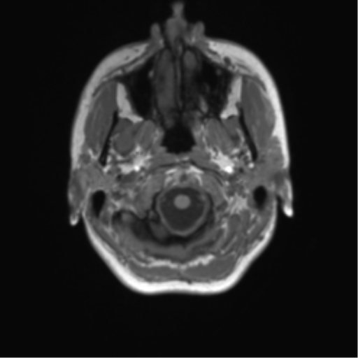 Cerebellar agenesis with hypoplastic pons (pontocerebellar hypoplasia) (Radiopaedia 57224-64138 Axial T1 8).png