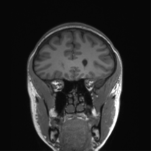 Cerebellar agenesis with hypoplastic pons (pontocerebellar hypoplasia) (Radiopaedia 57224-64138 Coronal T1 67).png