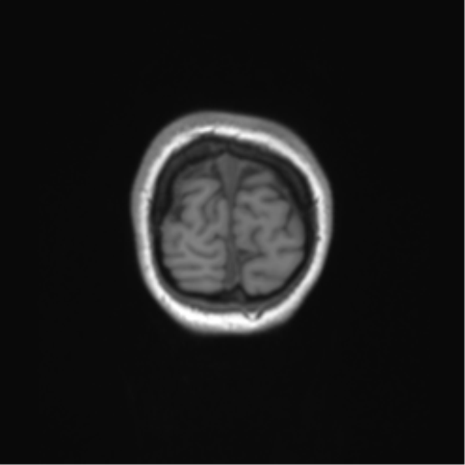Cerebellar agenesis with hypoplastic pons (pontocerebellar hypoplasia) (Radiopaedia 57224-64138 Coronal T1 9).png