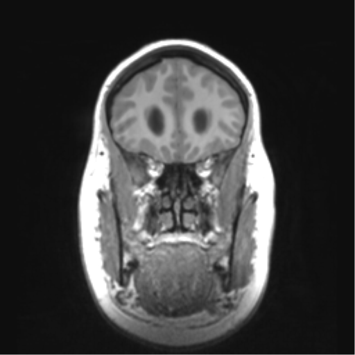 Cerebellar ependymoma complicated by post-operative subdural hematoma (Radiopaedia 83322-97736 Coronal T1 15).png