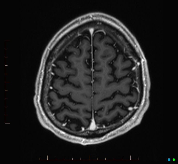 Cerebellar gangliocytoma (Radiopaedia 65377-74422 Axial T1 C+ 120).jpg