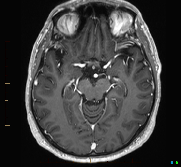 Cerebellar gangliocytoma (Radiopaedia 65377-74422 Axial T1 C+ 51).jpg