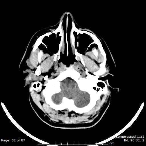 Cerebellar hemangioblastoma (Radiopaedia 52360-58258 Axial non-contrast 82).jpg